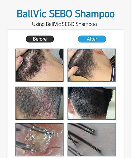 Ballvic Sebo Shampoo – Scalp Balance &amp; Soothing Care, 500g (17.6 oz)
